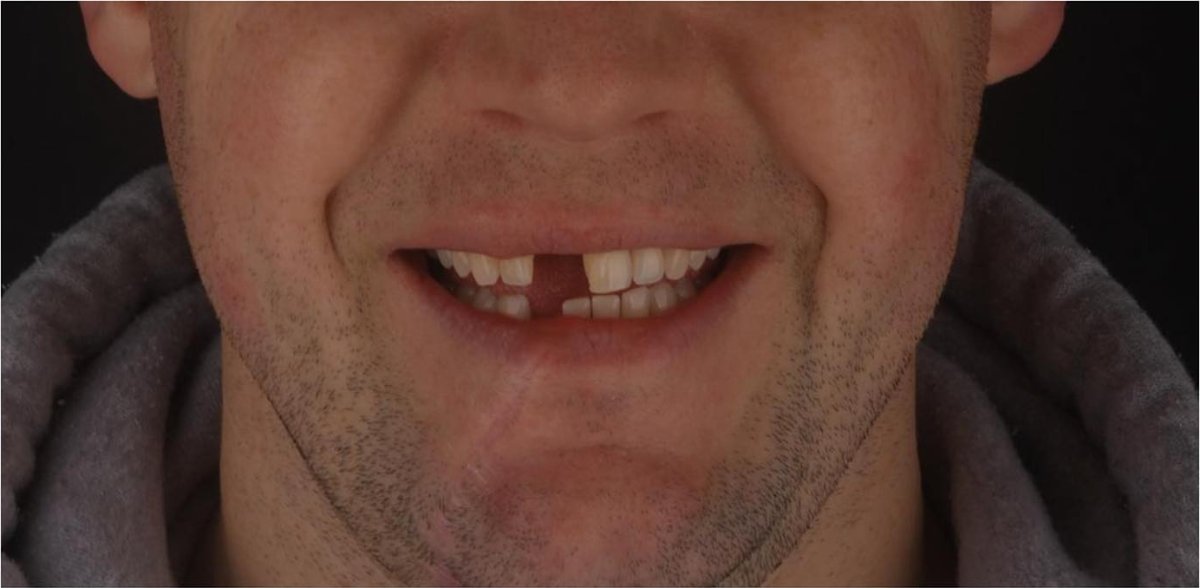 Smile with a missing front tooth before a dental bridge at Bespoke Dental