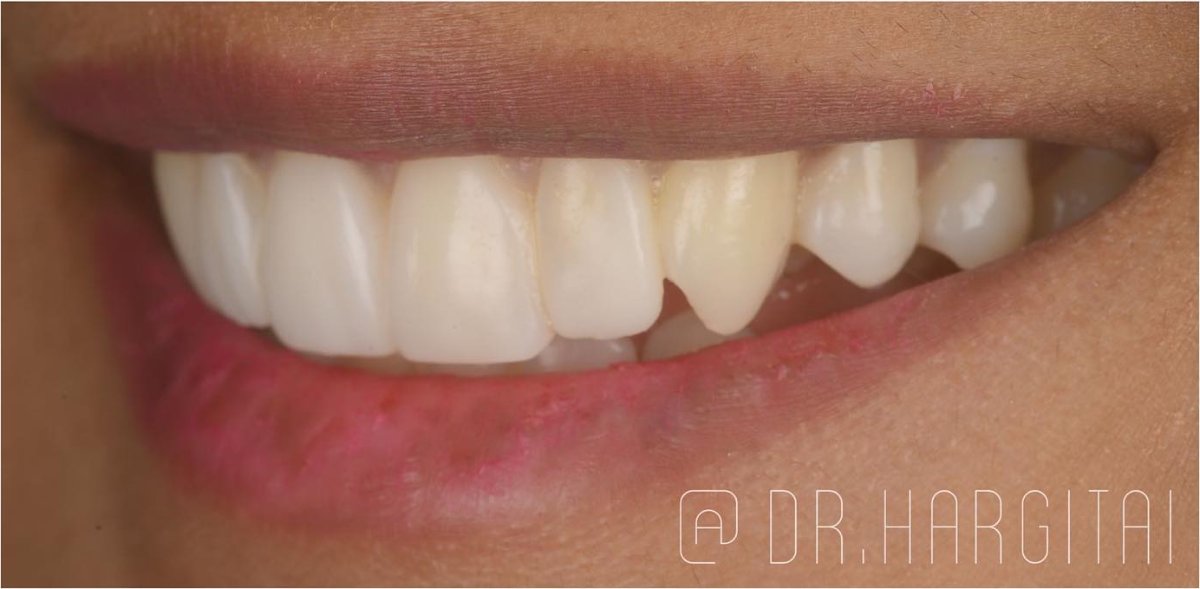 Smile after composite bonding at Bespoke Dental