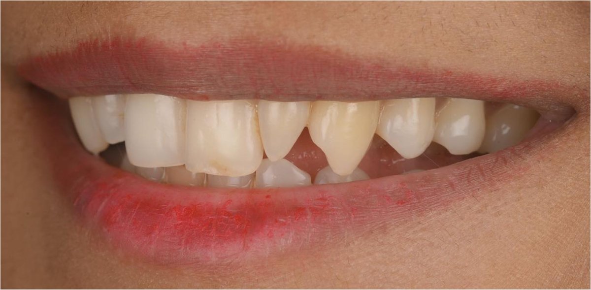 Smile before composite bonding at Bespoke Dental