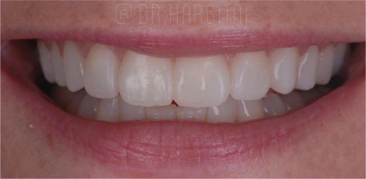 Smile after composite bonding at Bespoke Dental