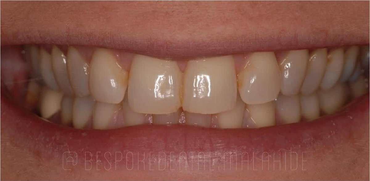 Smile before composite bonding at Bespoke Dental