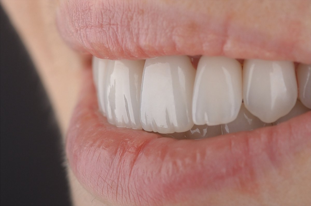 Teeth after dental crown treatment at Bespoke Dental