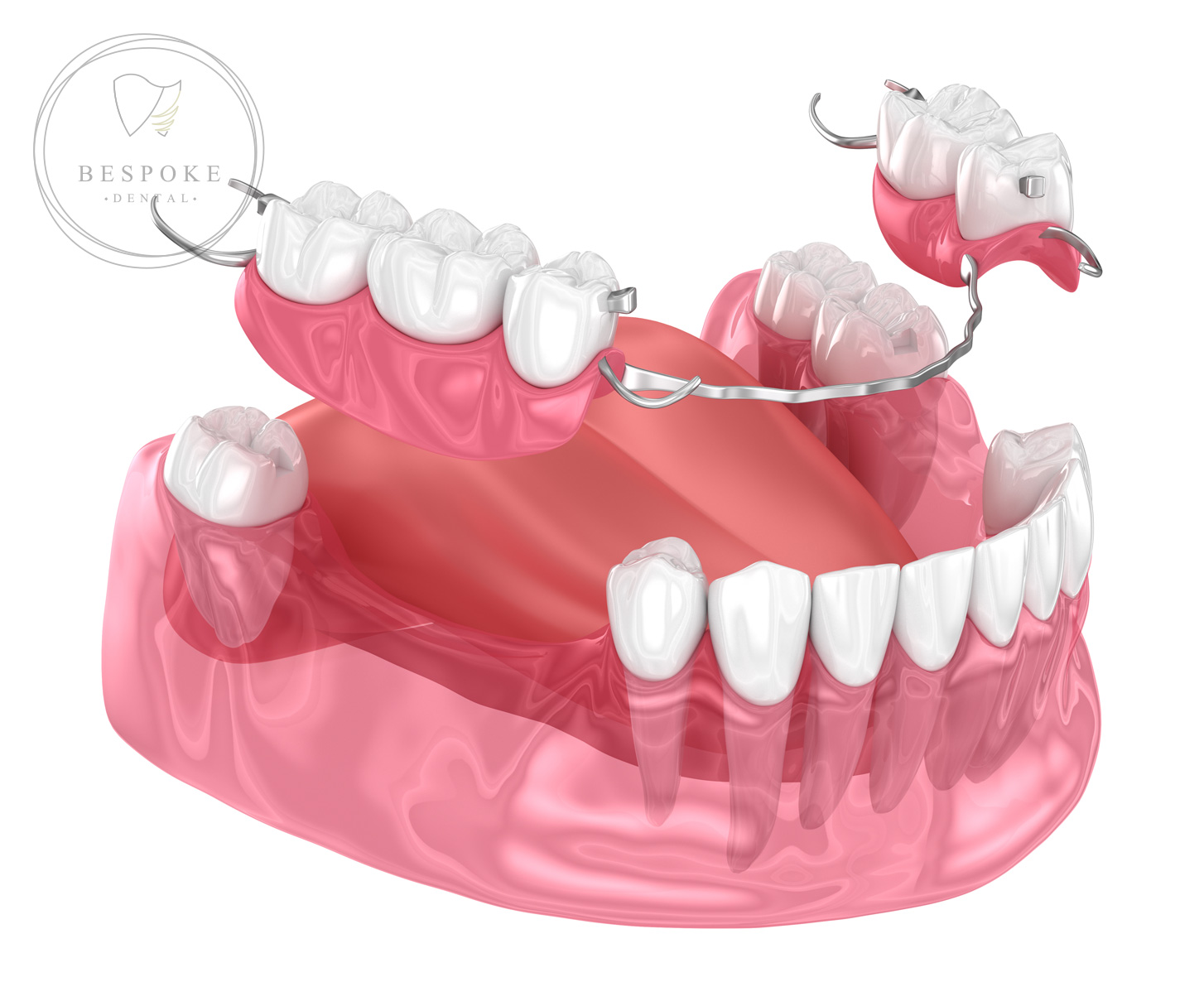Partial acrylic denture with metal clasps