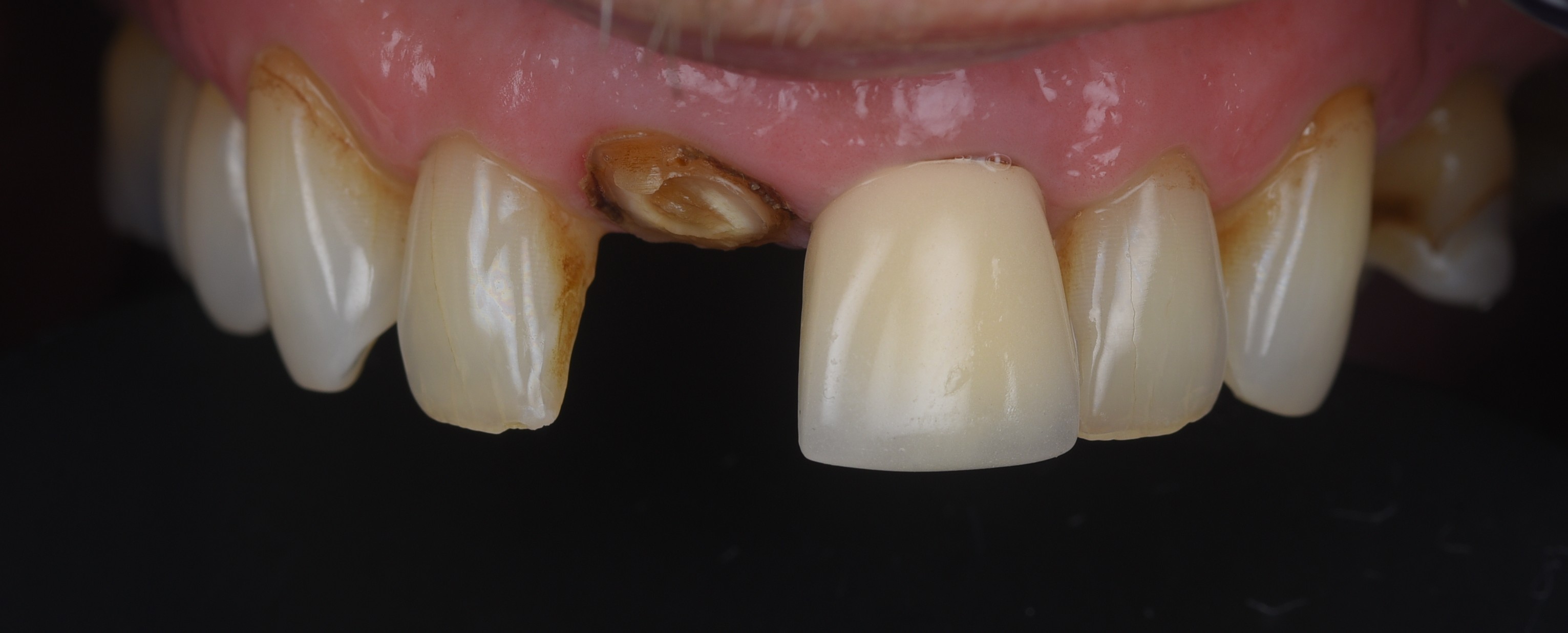 Damaged front tooth before immediate implant treatment at Bespoke Dental