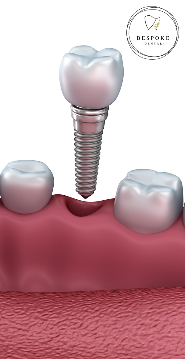 Diagram of a single tooth dental implant