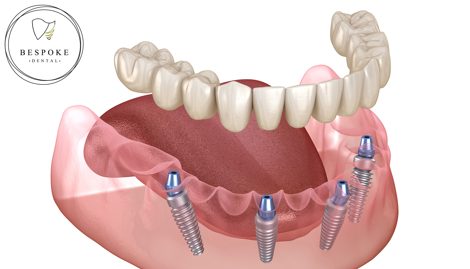 All-on-4 full arch dental implant treatment