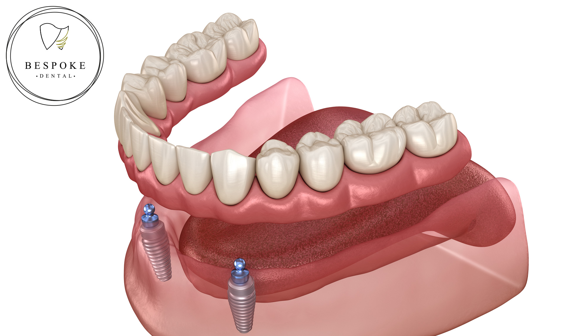 Implant supported denture