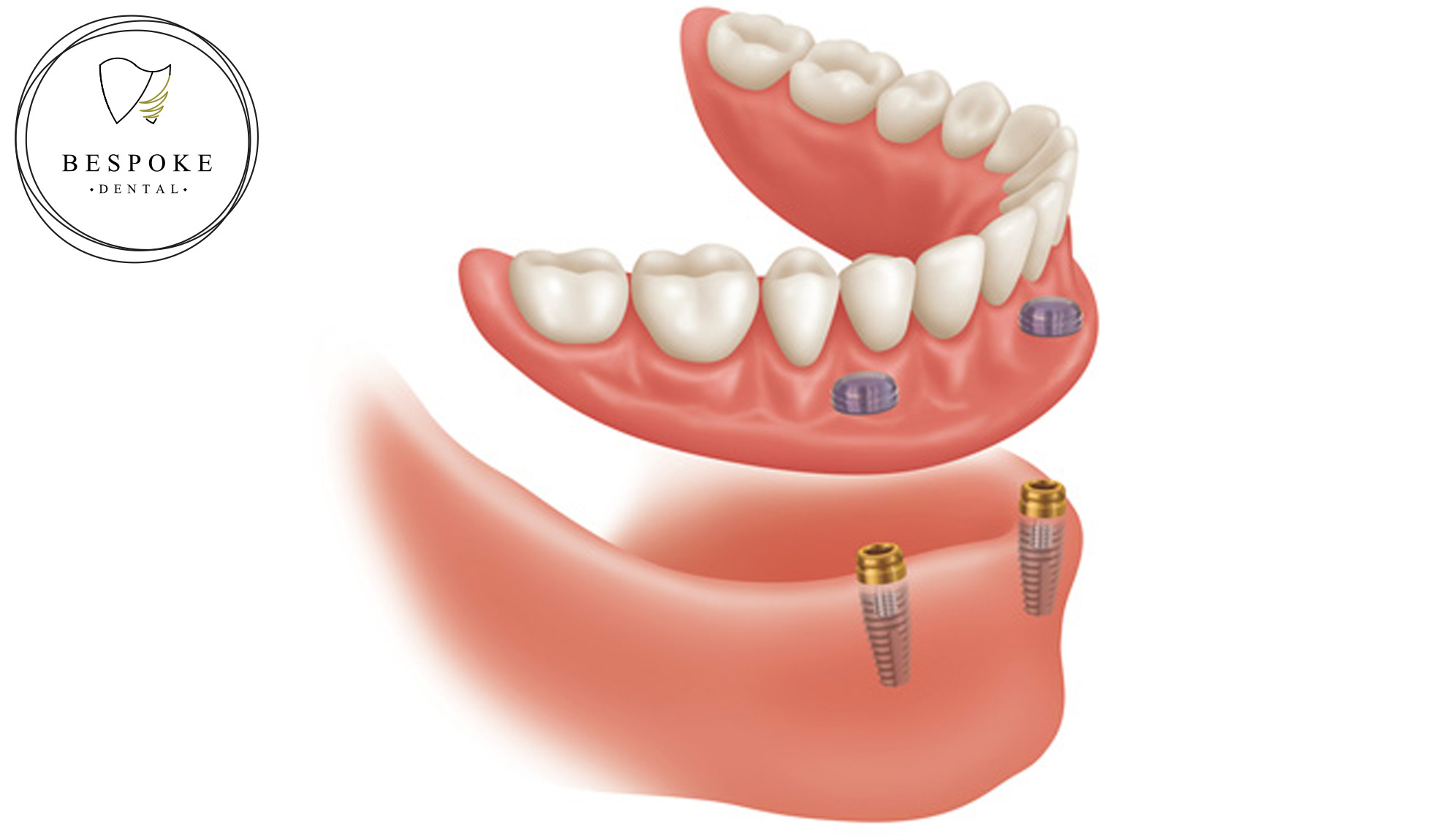 Implant-supported denture clipping onto two dental implants