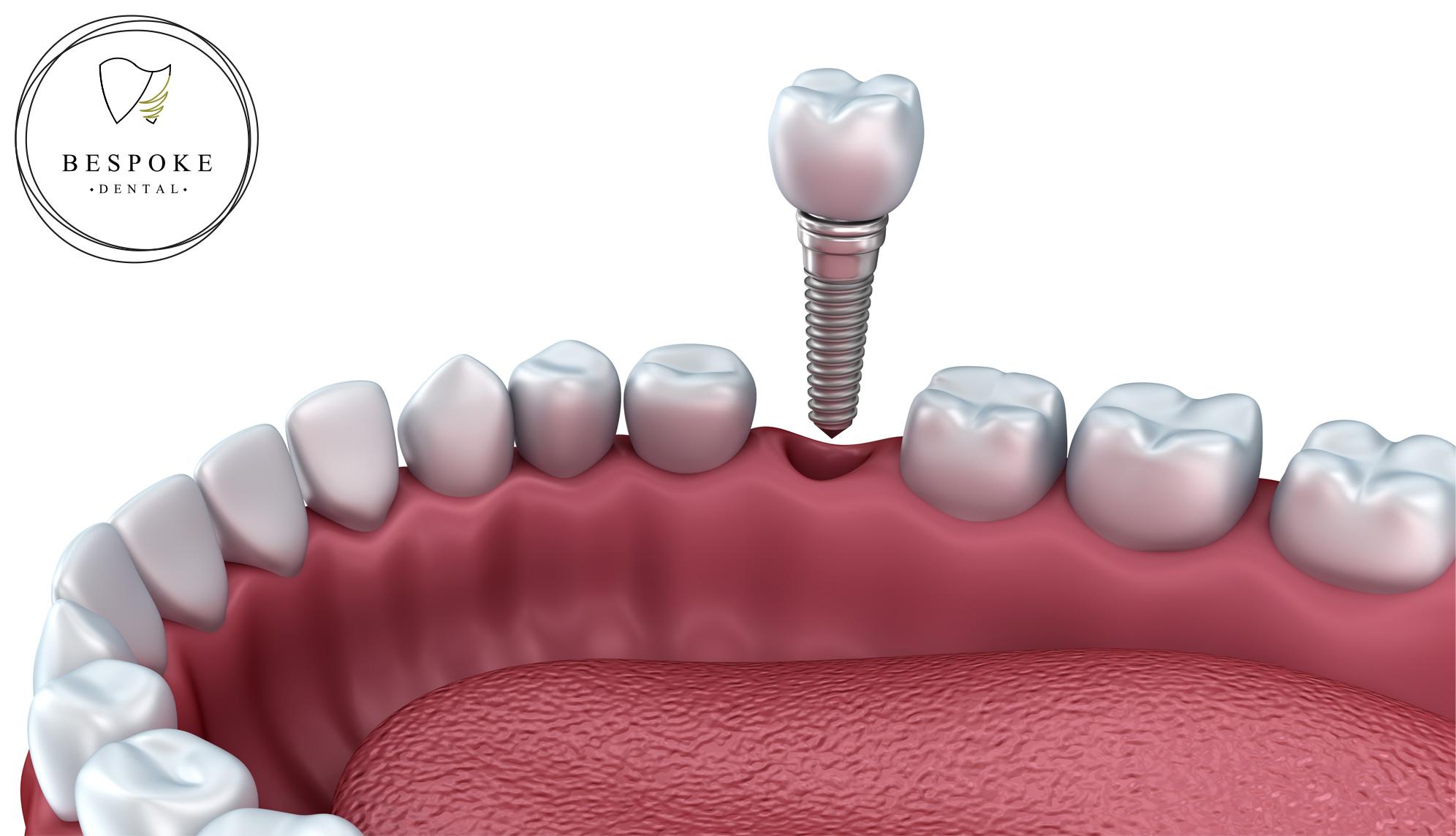 Single tooth dental implant treatment