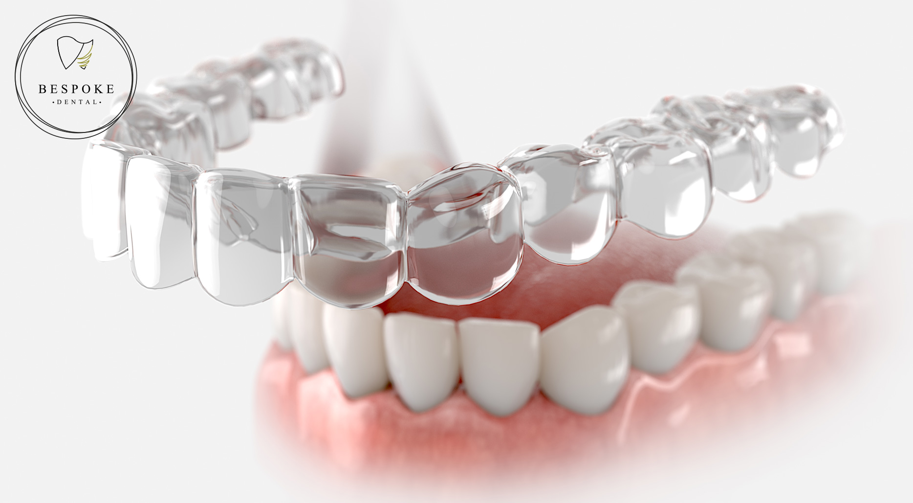 SPARK clear aligner
