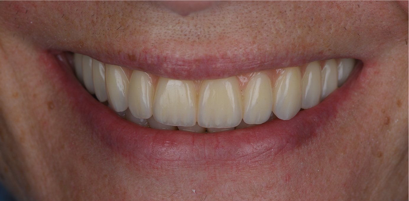 Smile after Teeth in a Day (All-on-4) treatment at Bespoke Dental