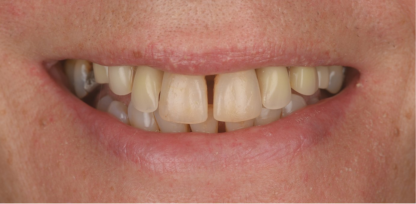 Smile before Teeth in a Day (All-on-4) treatment at Bespoke Dental