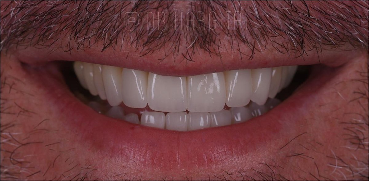 Smile after porcelain veneers at Bespoke Dental