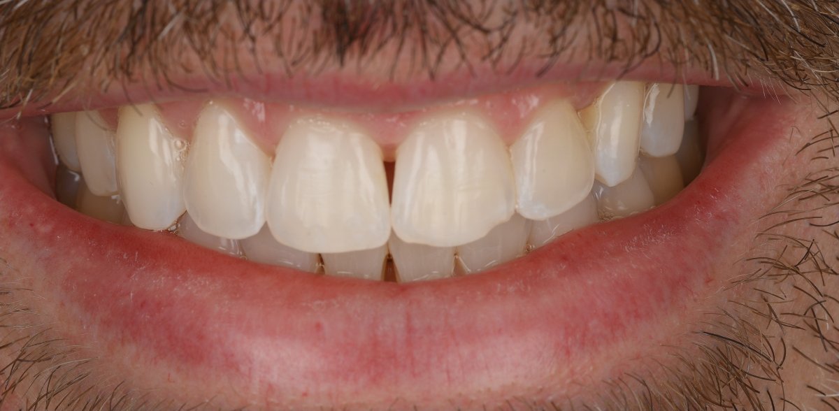 Smile before porcelain veneers at Bespoke Dental