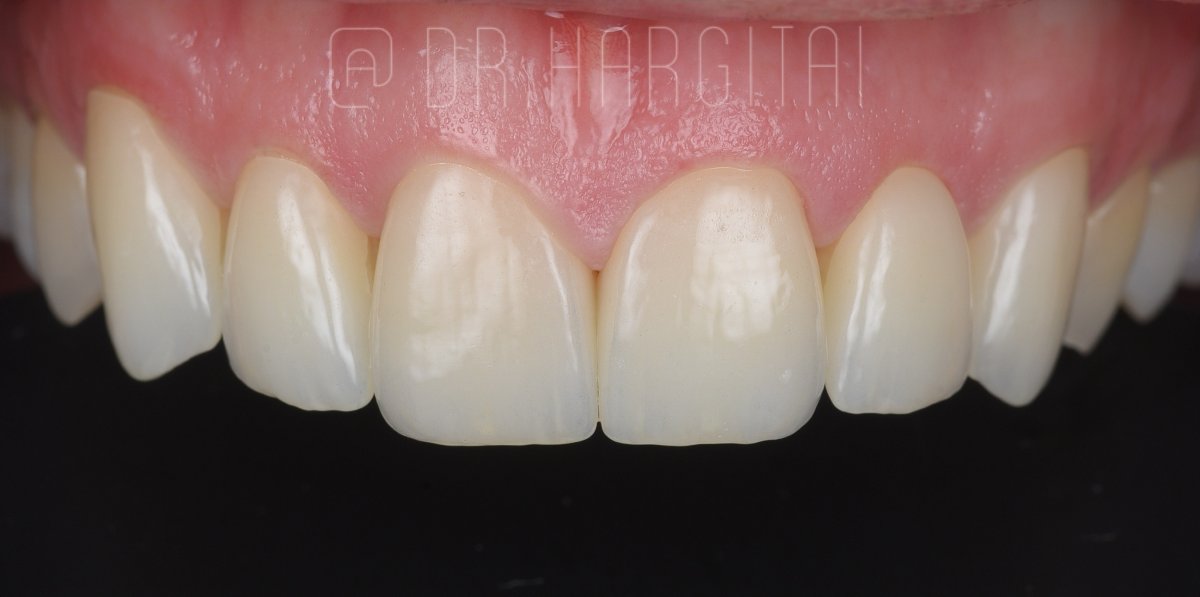 Smile after porcelain veneers at Bespoke Dental
