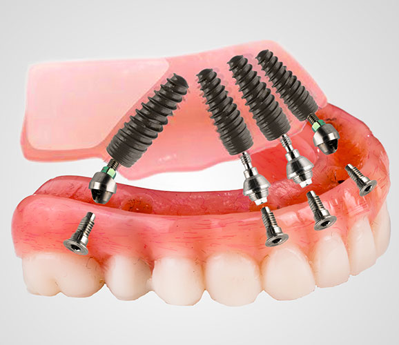 Partial tooth loss denture
