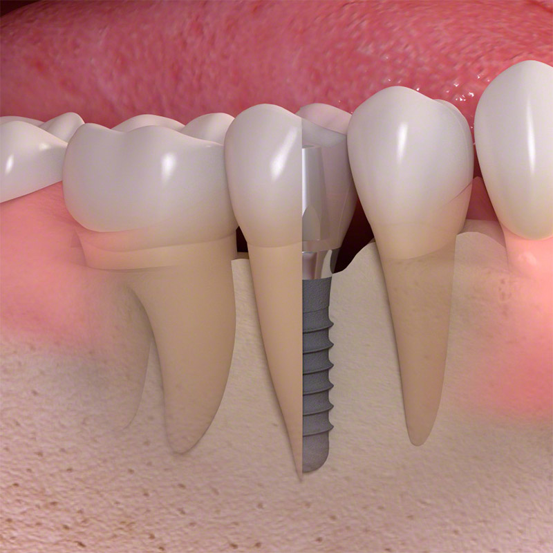 Implant Dentistry in Malahide